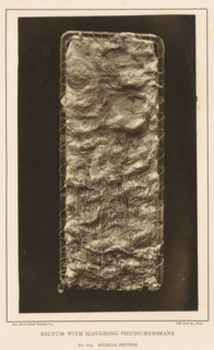 Rectum with Sloughing Pseudo-Membrane, page, photomechanical print, address: '1002 Arch St., Phila