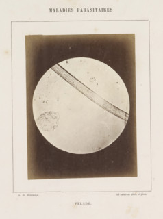Microscopic image of the disease alopecia areata, Pelade, photograph, page, inscription: 'Ad