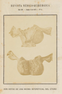 Dos Vistas de Una Mioma Intersticial del Útero, Two views of a uterus with a benign tumor formed by