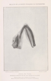 X-ray of a pheasant bone, Aileron de faison montrant la fracture de l'os, un esquille et un plomb,