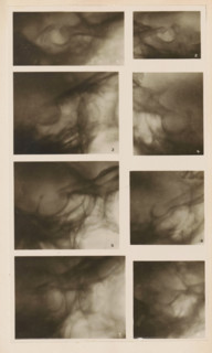 Eight x-rays, photograph, page, name: 'Dr. Alban Köhler', c. 1904 - in or before 1909,