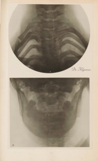 X-ray of ribs, photograph, page, name: 'Dr. Heilporn', c. 1904 - in or before 1909, photographer,