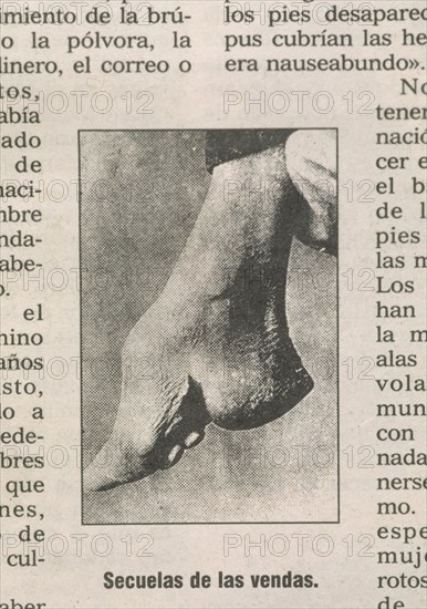 PERIODICO-FOTOGRAFIA:PIE MALFORMADO POR VENDAJE EN UNA MUJER CHINA

This image is not