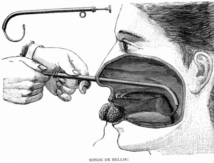 Belloc probe, cannula.Buffering of the nasal cavity
1887  ( Weekly journal by Dr. Gerard in Paris