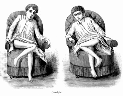 Coxalgia ( Tuberculosis of the hip ). Weekly magazine " Illustrated medecine "
by Dr. Gerard.
