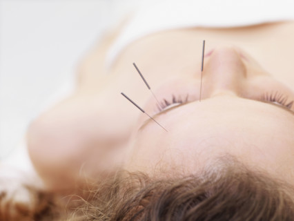 Woman receiving acupuncture. Date : 2008