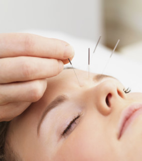 Woman receiving acupuncture. Date : 2008