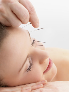Woman receiving acupuncture. Date : 2008