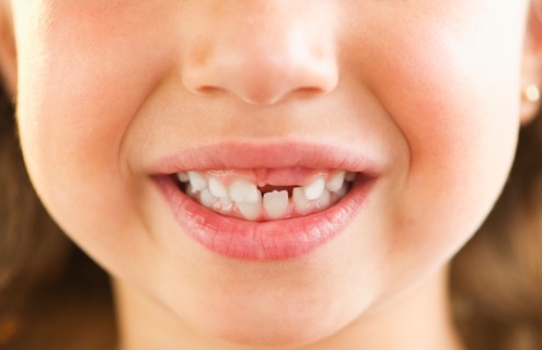 Close-up of girl's (2-3) mouth with some teeth missing. Photo : Daniel Grill