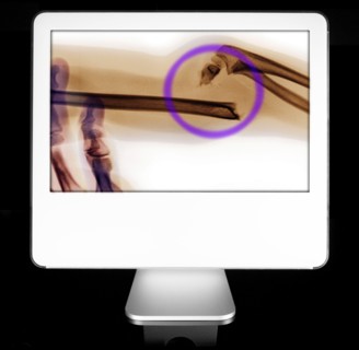 Bone fracture appearing on diagnostic monitor. 
Photo : Calysta Images