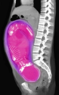 CT scan of abdomen of 25 year old pregnant woman with full term fetus. 
Photo : Calysta Images