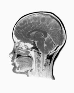 MRI Scan of human head. 
Photo : Calysta Images