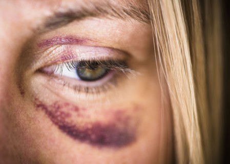 Portrait of woman with black eye. Photo : Jamie Grill