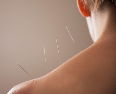 Close-up of Acupuncture needles in back. Photo : Mike Kemp