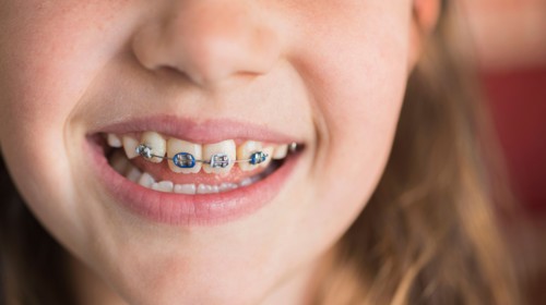 Close up of girl's (8-9) mouth with braces.