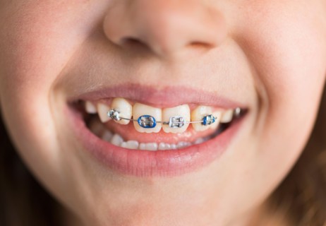 Close up of girl's (8-9) mouth with braces.