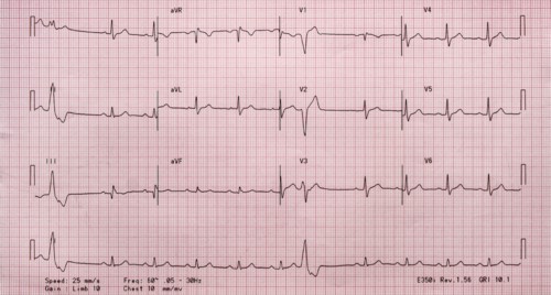 Electrocardiogram on red graph paper