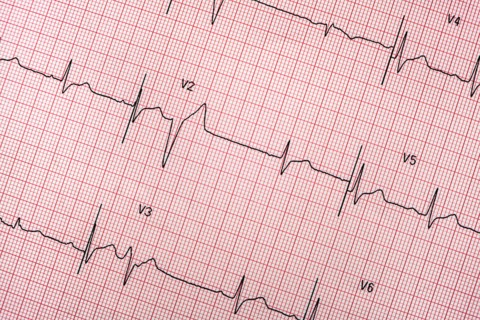 Electrocardiogram on red graph paper