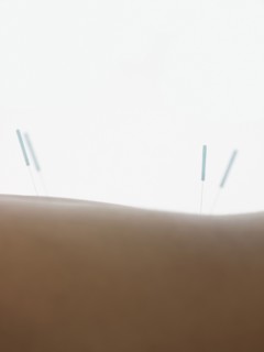 Close up of acupuncture needles in back of woman