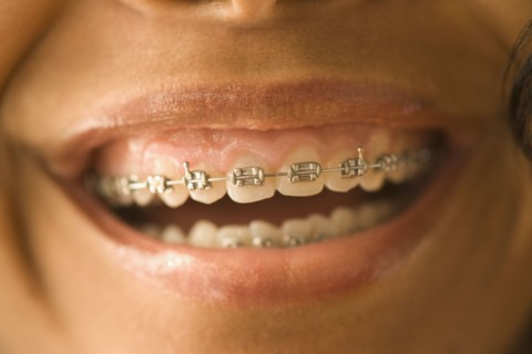 Close up of African woman with orthodontic braces