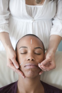 Black woman receiving acupuncture treatments