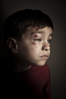 Mixed race boy with scrapes on his face