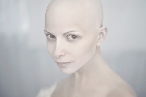 Caucasian woman with bald head