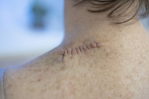 Medical stitches in woman's back after surgery