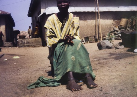 Psychiatry patient at Aro. Portrait of a female psychiatry patient, pictured outdoors at Aro Mental