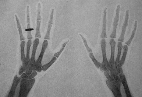 one of the first X-ray images of a human hand with ring
