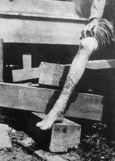 Man showing his leg with hook worm disese ca.  between 1910 and 1935