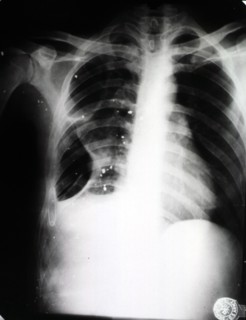 Ray showing chest wound