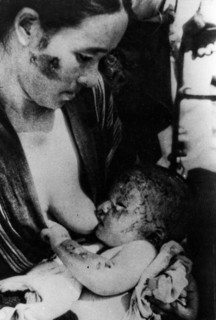 Mother And Son After The Atomic Explosion In Nagasaki.