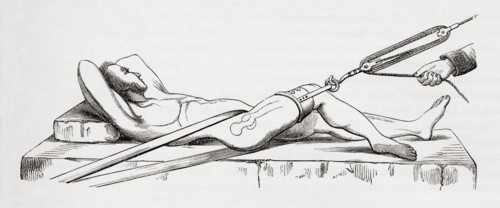 Reduction of dislocated thigh using pulleys.