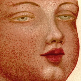 Eruptive Fevers: Scarlatina or Scarlet Fever.