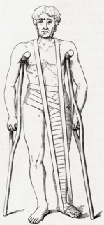 Mode of support for a fractured thigh in old persons.
