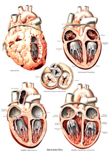 Anatomy, human, various pathological changes of the human heart, fatty degeneration of the heart,