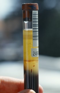 HEALTH, Blood, Serum in test tube