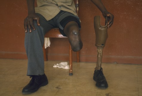 MOZAMBIQUE, Maputo, Mine victim holding prosthetic limb.Central Hospital