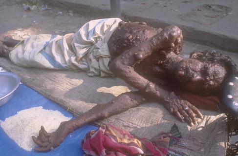 BANGLADESH, Dhaka, Elderly man suffering from a medical condition called Neurofibromatosis