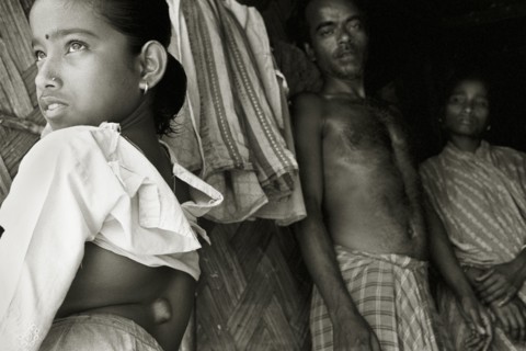 INDIA, West Bengal, Mal, Parents display a growth on their daughter's spine in a West Bengal