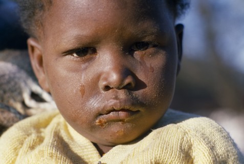 SOUTH AFRICA, Gauteng, Soweto, "Portrait of young child with dirty, tear stained face and sores