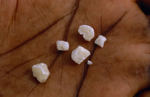 COLOMBIA, Vaupes, "Crystalized cocaine base displayed on palm of hand in illegal lab. in Vaupes